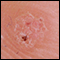 Photograph of plantar warts on bottom of foot
