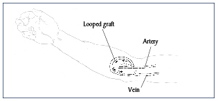 Illustration of a looped graft.