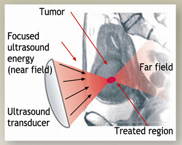 focused ultrasound illustration 1