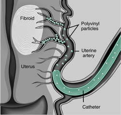 close up of uterine fibroid embolization