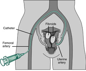 uterine fibroid embolization overview