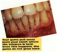 Your gums pull away from your teeth...