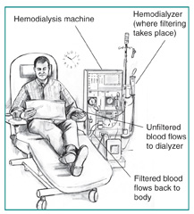Drawing of a man receiving hemodialysis treatment. Labels point to the hemodialyzer, where filtering takes place; hemodialysis machine; a tube where unfiltered blood flows to the dialyzer; and a tube where filtered blood flows back to the patient’s body.