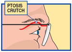 ptosis crutch