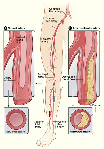 The illustration shows how P.A.D. can affect arteries in the legs. Figure A shows a normal artery with normal blood flow. The inset image shows a cross-section of the normal artery. Figure B shows an artery with plaque buildup that’s partially blocking blood flow. The inset image shows a cross-section of the narrowed artery.