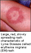 Large, red, slowly spreading rash characteristic of Lyme Disease.