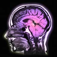 image- MRI image of a woman's head