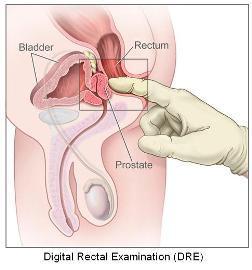 Digital Prostate Examination (DRE)