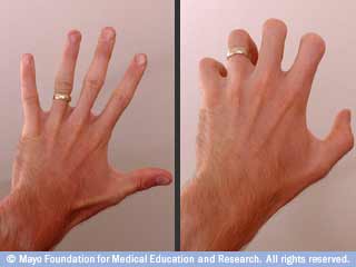 Photos of hand with fingers extended and bent