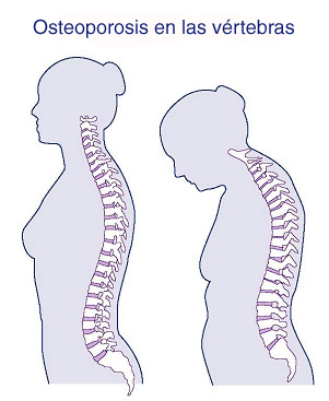 Osteoporosis en las vértebras