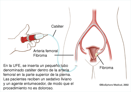 En la UFE, se inserta un pequeño tubo denominado catéter dentro de la arteria femoral en la parte superior de la pierna. Las pacientes reciben un sedativo liviano y un agente entumecedor, de modo que el procedimiento no es doloroso
