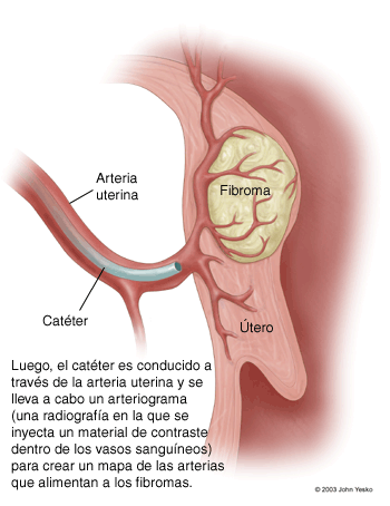 Luego, el catéter es conducido a través de la arteria uterina y se lleva a cabo un arteriograma (una radiografía en la que se inyecta un material de contraste dentro de los vasos sanguíneos) para crear un mapa de las arterias que alimentan a los fibromas.