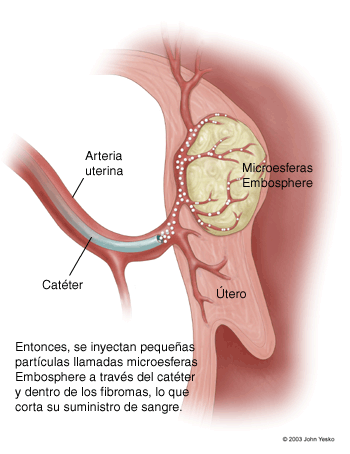 Entonces, se inyectan pequeñas partículas llamadas microesferas Embosphere a través del catéter y dentro de los fibromas, lo que corta su suministro de sangre.