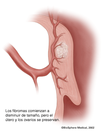 Los fibromas comienzan a disminuir de tamaño, pero el útero y los ovarios se preservan.