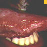 Photo: Hairy Leukoplakia