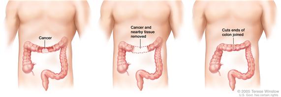 Three-panel drawing showing colon cancer surgery with anastomosis; first panel shows the  area of the colon with cancer, middle panel shows the cancer and nearby tissue removed, last panel shows the cut ends of the colon joined.