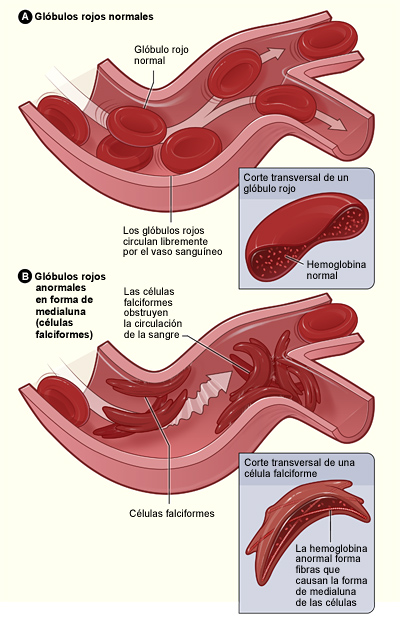 La figura A muestra glóbulos rojos normales que circulan libremente en un vaso sanguíneo. Dentro del recuadro se observa un corte transversal de un glóbulo rojo normal que contiene hemoglobina normal. La figura B muestra células falciformes que forman un grupo y se atascan en un vaso sanguíneo. (Es posible que otras células también participen en este proceso). Dentro del recuadro se observa un corte transversal de una célula falciforme que contiene hemoglobina anormal.