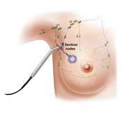 Sentinel lymph node biopsy.  Second of three panel illustration showing radioactive substance and/or blue dye is injected near the tumor, the injected material is followed visually or with a probe, and the first lymph nodes to take up the material are removed and checked for cancer cells.