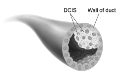 This picture shows ductal carcinoma in situ.