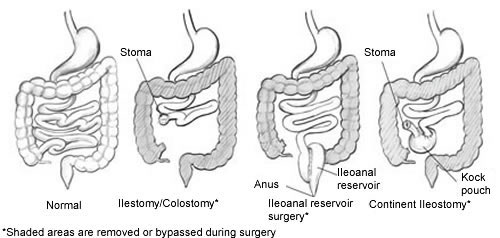 Drawings of a normal bowel and three types of bowel diversion surgeries, including ileostomy/colostomy, ileoanal reservoir, and continent ileostomy. The normal bowel drawing shows the stomach, small intestine, and large intestine. The ileostomy/colostomy drawing shows the stomach and a shortened small intestine that ends at a stoma. It also shows the large intestine, which is shaded to indicate it has been removed or bypassed during surgery. The stoma is labeled. The ileoanal reservoir surgery drawing shows the stomach and a shortened small intestine whose end has been turned into an ileoanal reservoir. It also shows the large intestine, which has been shaded to indicate it has been removed or bypassed during surgery. The anus and ileoanal reservoir are labeled. The continent ileostomy drawing shows the stomach and a shortened small intestine whose end has been turned into a Kock pouch. It also shows the large intestine, which is shaded to indicate it has been removed or bypassed during surgery. A short segment of bowel protrudes from the Kock pouch and ends at a stoma. The Kock pouch and stoma are labeled.