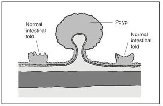 Drawing of a colon polyp with labels pointing to one polyp and two normal intestinal folds.