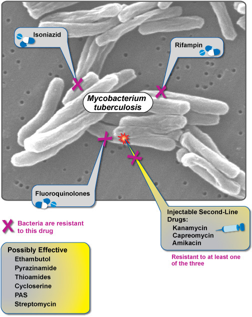 Extensively Drug-Resistant TB (XDR TB)