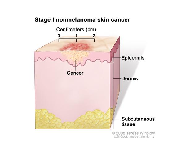 Stage I nonmelanoma skin cancer; drawing shows a tumor in the epidermis (outer layer of the skin) that is no more than 2 centimeters wide. Also shown are the dermis (inner layer of the skin) and the subcutaneous tissue below the dermis.