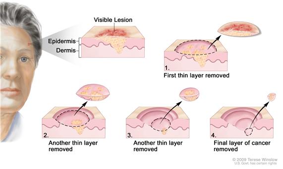 Mohs surgery; drawing shows a patient with skin cancer on the face. The pullout shows a block of skin with cancer in the epidermis (outer layer of the skin) and the dermis (inner layer of the skin). A visible lesion is shown on the skin’s surface. Four numbered blocks show the removal of thin layers of the skin one at a time until all the cancer is removed.