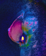 MRI scan showing breast cancer - Copyright: Science Photo Library