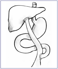 Drawing of the Kasai procedure for biliary atresia. Part of the small intestine is attached to the liver and replaces the bile ducts so the liver can drain properly.