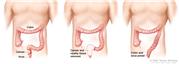 Three-panel drawing showing rectal cancer surgery with anastomosis; first panel shows area of rectum with cancer, middle panel shows cancer and nearby tissue removed, last panel shows the colon and anus joined.