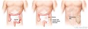 Three-panel drawing showing colon cancer surgery with colostomy; first panel shows the area of the colon with cancer, middle panel shows the cancer and nearby tissue removed and a stoma created, last panel shows a colostomy bag attached to the stoma.