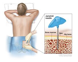 Bone marrow aspiration and biopsy; drawing shows a patient lying face down on a table and a Jamshidi needle (a long, hollow needle) being inserted into the hip bone. Inset shows the Jamshidi needle being inserted through the skin into the bone marrow of the hip bone.