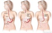 Three-panel drawing showing esophageal cancer surgery; first panel shows area of esophagus with cancer, middle panel shows cancer and nearby tissue removed, last panel shows the stomach pulled up and joined to the remaining esophagus.