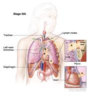 Stage IIIA non-small cell lung cancer; drawing shows cancer in the lymph nodes, the left main bronchus, pleura, diaphragm, and chest wall. One inset shows a close up of cancer spreading from the lung into the pleura and chest wall; another inset shows a close up of cancer spreading from the lung into the pericardium (membrane around the heart).