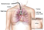 Mediastinoscopy; shows mediastinoscope with light and lens inserted into
the chest through an incision above the breastbone. Drawing shows right
and left lungs, trachea, and lymph nodes. Inset shows anterior
mediastinotomy (Chamberlain procedure) with incision beside the
breastbone.