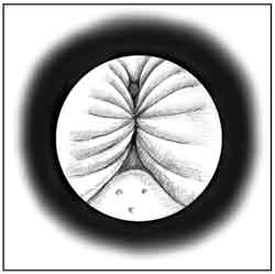 Drawing of the inside of the urethra, as seen through a cystoscope. The sides of the urethra are pushed together, leaving little space for urine flow.