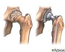 Illustration of a hip joint before and after hip replacement
