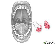 Illustration of a tonsillectomy