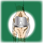 Illustration: Knee replacement