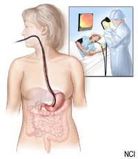 Illustration of an upper endoscopy