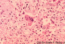 Histopathology of measles pneumonia