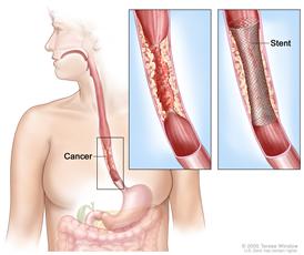 Esophageal stent. Shows cancer blocking esophagus. Insets show  enlarged area of cancer and a stent placed in the esophagus to keep it open.