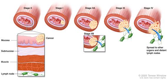 Esophageal  cancer staging; shows tumors growing through layers of the esophagus wall for Stage 0, Stage I, Stage II, Stage III, and Stage IV esophageal  cancer. Inset shows muscle, submucosa, and mucosa layers of the esophagus  wall, and lymph nodes.