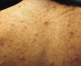 The back of an adult with chickenpox