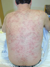 An adult with chickenpox