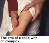 The arm of a child with chickenpox