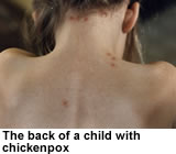 The back of a child with chickenpox