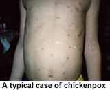 A typical case of chickenpox