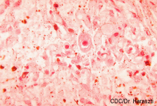 Histopathology of cytomegalovirus infection of lung